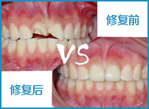 北京做烤瓷牙需要多长时间