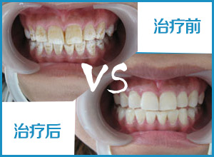 冷光美白可以治疗氟斑牙吗?