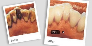北京超声波洗牙有什么副作用吗